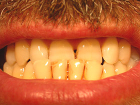 malocclusione dentaria