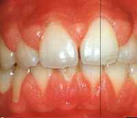 esempio gengiva malata