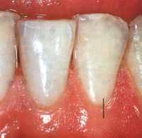 esempio gengiva sana
