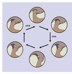 lussazione condilo mandibola