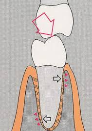 limare i denti