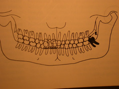 dente del giudizio e gengive